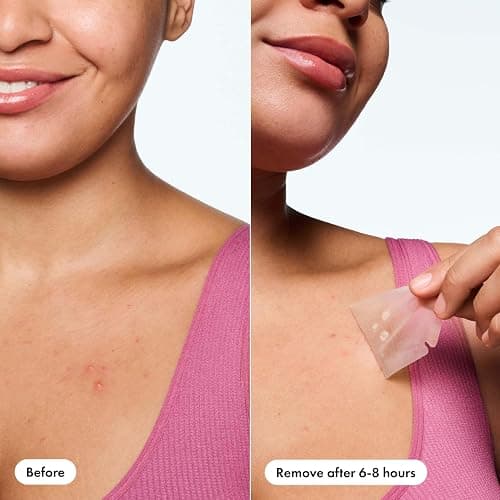 Mighty Patch Hero Cosmetics Body Patch– The XXL Hydrocolloid Patch for Bacne, Chestne, and Other Body Breakouts. Derm-Tested. Medical-Grade Hydrocolloid. Absorbs Pimple Gunk in 6-8 Hours. 4ct thumbnail 6