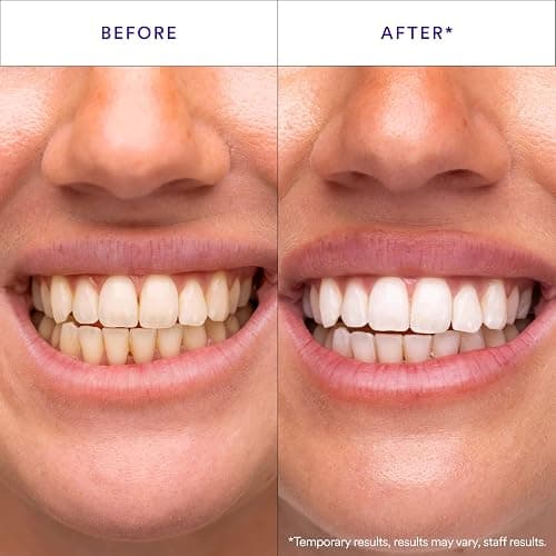 Hismile V34 Whitening Strips, Teeth Whitening Strips, Purple Tooth Whitening, Purple V34 Whitening Strips, Tooth Stain Treatment, Combining Whitening and Colour Correction thumbnail 2