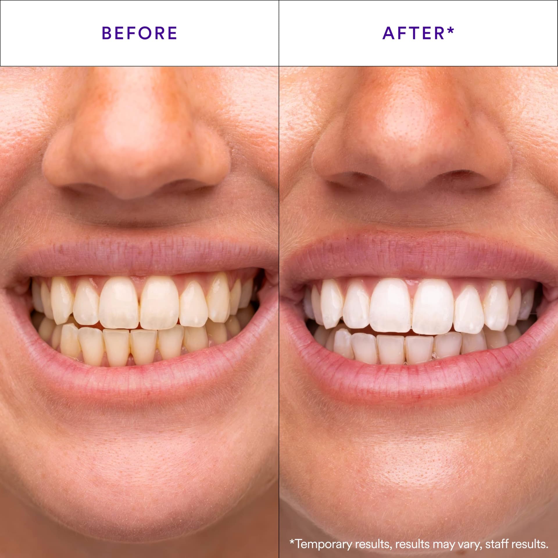 Hismile V34 Purple Teeth Whitening Strips, 14 Count, Peroxide-Free, Brightens Teeth in 30 Minutes, Combines Whitening and Colour Correction thumbnail 2