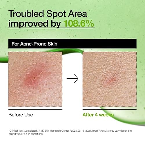 Anua Azelaic Acid 10 Hyaluron Redness Soothing Serum, Facial Serum for Troubled & Sensitive skin, Breakouts, Hyaluronic Acid, Niacinamide, Spot Care, Natural Color, Korean Skincare (30ml/ 1.01 fl oz.) thumbnail 5