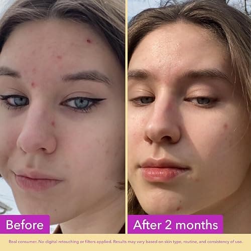 Good Molecules Niacinamide Serum – 10% Niacinamide to Target Blemishes, Nourishment, and Skin Tone – Ultra Hydrating & Brightening Skin Care for Face – 75 ml / 2.53 fl oz thumbnail 3
