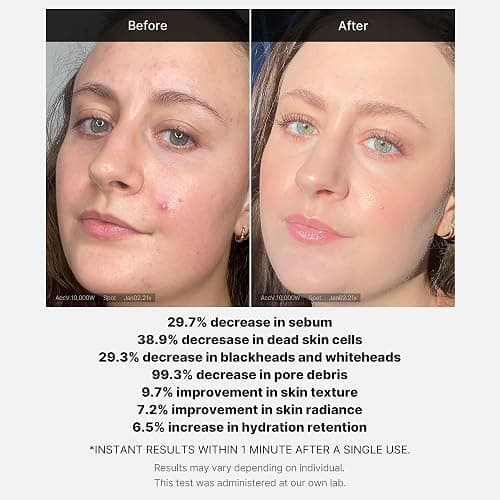 Medicube 21% Acid Wash-off Exfoliant (AHA+BHA+Succinic Acid), Wash-off Resurfacing Serum, Best for bumpy, breakout-prone skin, Korean Skincare (1.41fl.oz.) thumbnail 4