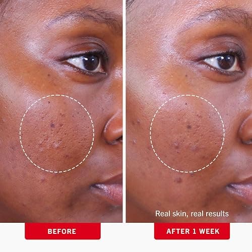 First Aid Beauty Acne Pads for Face - Maximum Strength Acne Treatment - 2% Salicylic Acid Pads Treat Without Drying, (60-ct) thumbnail 4