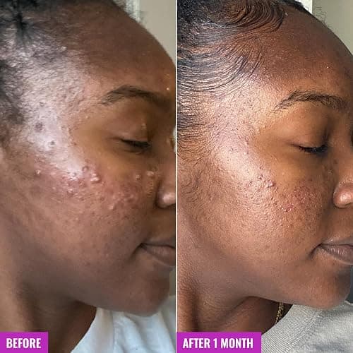 Good Molecules Acne Foaming Cleanser - 2% Salicylic Acid Foam Cleanser - Gentle Acne Face Wash with Alcohol Free Witch Hazel and Aloe - Skin Care for Face thumbnail 5