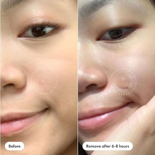 Hero Cosmetics Mighty Patch Original Nighttime Acne Pimple Patches, 75 Ct | #1 Hydrocolloid Acne Patches, Shrinks Zits & Whiteheads in 1 Use, Spot Treatment Pimple Stickers for Face thumbnail 5