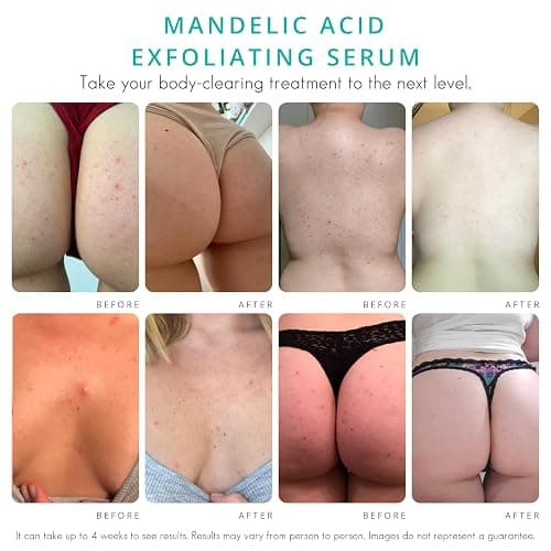 Almond Clear Level 2 Serum | Mandelic Acid Body Serum for Acne, Folliculitis, Aging Skin, Ingrown Hairs, Dark Spots on Face, Chest, Butt, Back, Thighs, Arms | 4 oz thumbnail 3
