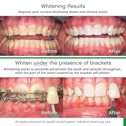 Opalescence Teeth Whitening Bundle - Opalescence Go 15% Hydrogen Peroxide Prefilled Trays (10 Trearments) and Sensitive Whitening Toothpaste 4.7 Onz - Mint Flavor 5194-5167 thumbnail 4