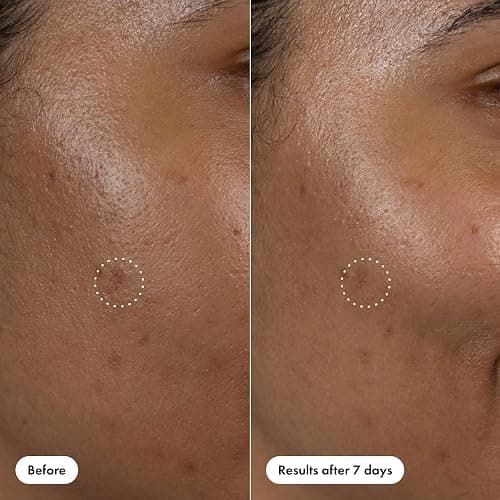 Hero Cosmetics Dark Spot Correct Spot-Fading 15% Vitamin C plus Hyaluronic Acid Serum. Improves the Look of Post Blemish Marks in 7 Days. Twist Applicator and Rollerball Tip for Easy Application. 10mL thumbnail 7