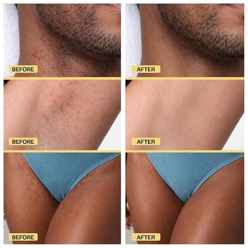 BASE LABORATORIES Ingrown Hair Treatment Oil – Soothing After Shave Oil Prevents Ingrown Hairs, Soothes Razor Bumps for Bikini Area, Legs, Underarms, Neck, Beard & Face – Tea Tree, Jojoba 1oz (30ml) thumbnail 6