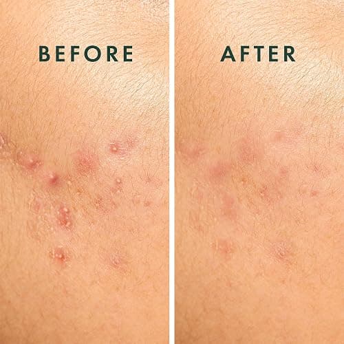 Rael Pimple Patches, Miracle Spot Control Cover - Hydrocolloid Acne Pimple Patch, Strips for Zits and Blemish, Korean Skin Care (20 Count) thumbnail 6