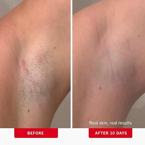 First Aid Beauty - Ingrown Hair Pads with BHA + AHA - Aftershave Treatment Pads to Help Prevent Razor Bumps for Men & Women - Exfoliate Underarms & Bikini Area - Compostable for Daily Use - 28 Pads thumbnail 3