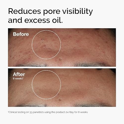 The Ordinary Niacinamide 10% + Zinc 1%, Smoothing Serum for Blemish-Prone Skin thumbnail 2