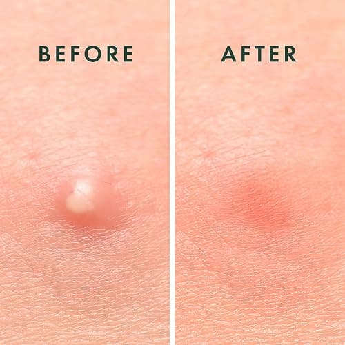 Rael Pimple Patches, Miracle Invisible Spot Cover - Hydrocolloid Acne Pimple Patch, Absorbs Zits & Blemish, Korean Skin Care, 2 Sizes (24 Count) thumbnail 6