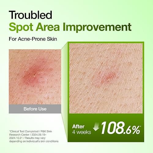 Anua Azelaic Acid 10 Hyaluron Redness Soothing Serum, Facial Serum for Blemish-Prone & Oily-Prone Skin, Lightweight & Hydrating Blemish Care, Hyaluronic Acid, Korean Skincare, 1.01 fl oz. thumbnail 5