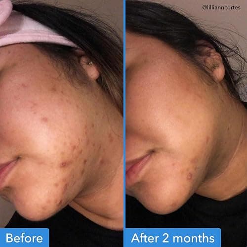 Good Molecules Discoloration Correcting Serum - Tranexamic Acid and Niacinamide Serum to Target Dark Spots and Hyperpigmentation - Skin Care for Face thumbnail 3