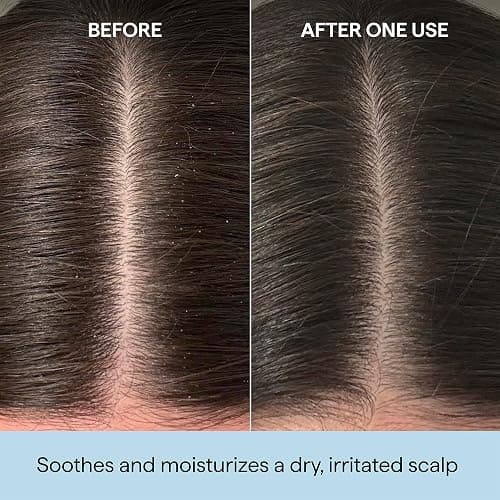 Briogeo Scalp Revival Rosemary Pre-Wash Oil | Moisturizing Scalp Treatment for Dry, Flaky, or Itchy Scalp | Strengthens Hair & Soothes Scalp | Vegan & Cruelty-Free thumbnail 2