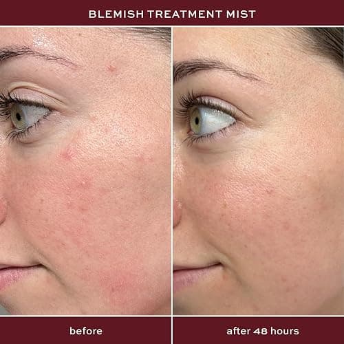ITK Skincare 2% Salicylic Acid Spray for Face & Body Acne - Blemish-Fighting Treatment for Body Acne, Bacne, Blackheads, Pimples & Blemishes - BHA Blemish Facial Mist Post Workout - 3.3oz Spray Bottle thumbnail 3