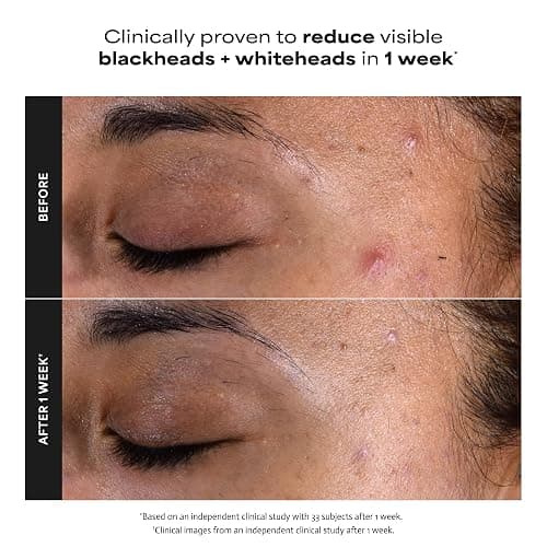 Paula's Choice SKIN PERFECTING 2% BHA Liquid Exfoliant - Face Exfoliating Peel Fights Blackheads & Enlarged Pores - for a Healthy Glow - with Salicylic Acid - Combination & Oily Skin - 30 ml thumbnail 7