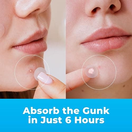 PatchRx Pimple Patches for Face (120 Patches), Hydrocolloid Pimple Patches - Pimple Patch Zit Patch and Pimple Stickers - Hydrocolloid Pimple Dots for Pimples - Zit Patches thumbnail 4