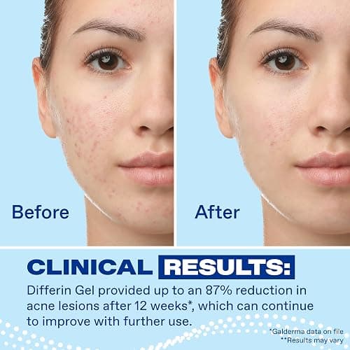 Differin Acne Retinoid Treatment Gel, 0.1% Adapalene, 45g Pump | 90-Day Supply Pump, Over-The-Counter Retinoid, Clears Breakouts, Gentle For Sensitive Skin, Dermatologist Recommended thumbnail 6