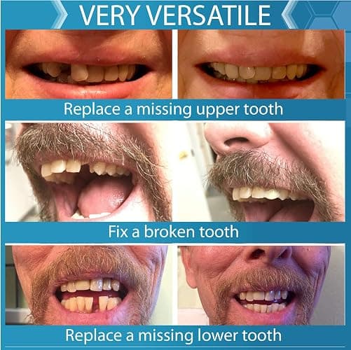 Instant Smile Complete Your Smile Temporary Tooth Replacement Kit - Replace a Missing Tooth in Minutes - Patented | Replace a Missing Tooth in Minutes, Patented thumbnail 6