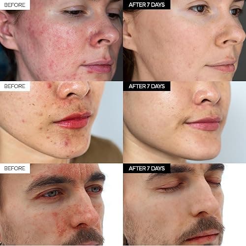 IVOSKIN Intensive Cica Repair Cream, Korean Dexpanthenol cream, Restore Skin Barrier, Prevent Acne Breakouts, Ultra-Soothing & Hydrating Care Cream for Sensitive Skin with Madecassoside (1.76oz / 50g) thumbnail 3