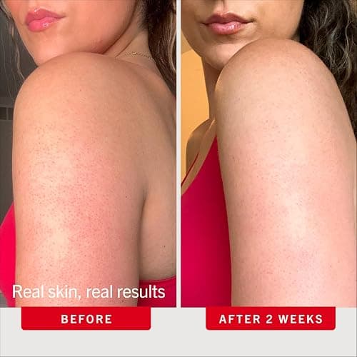 First Aid Beauty KP Bump Eraser Body Scrub with 10% AHA - Dermatologist-Tested Keratosis Pilaris Exfoliator - Support for Rough Bumps, Uneven Skin Texture & Strawberry Skin - Sensitive Skin thumbnail 4