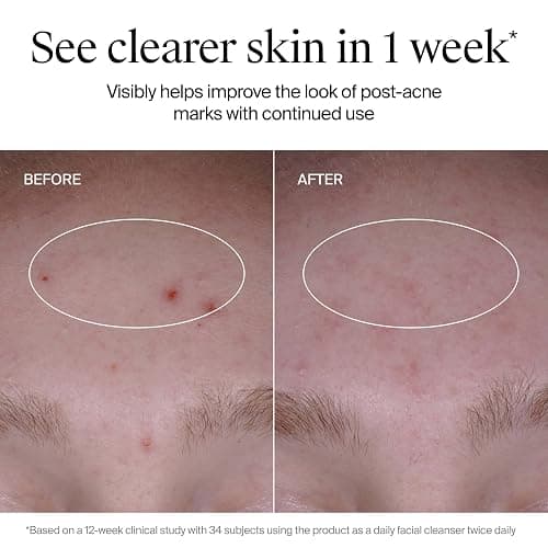Neutrogena Evenly Clear Acne Cleanser with 2% Salicylic Acid & 2% PHA Exfoliant, Gentle Foaming Face Wash Clears Clogged Pores & Blackheads While Visibly Fading Look of Post-Acne Marks, 9.1 fl. oz thumbnail 6