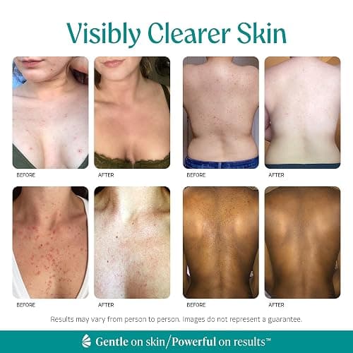 Body Clearing Serum [1 Fl Oz] Level 2 Acne Serum - Advanced Formula for Body Acne, Folliculitis, Back, Butt, Chest, Thighs, Shoulders - Mandelic Acid thumbnail 3
