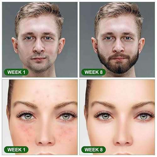 URAQT Dermaroller Microagujas, 1.5mm Rodillo Derma para Cara y Cuerpo, Rodillos Facial de Titanio Microagujas, Herramientas de Aseo para Anti-Edad, Eliminación de Cicatrices Acne, Poro Contractivo thumbnail 6