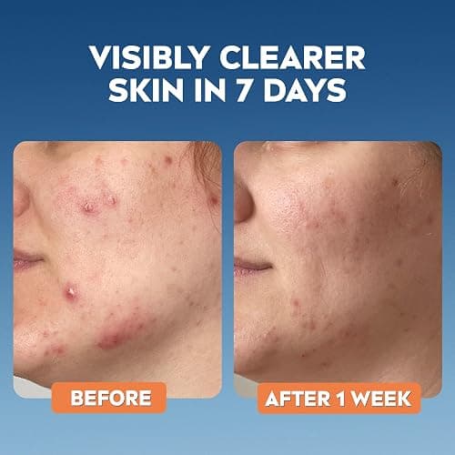 NIVEA Derma Skin Clear Wash Gel (150ml), Deep Cleansing Salicylic Acid Face Wash Enriched with Niacinamide to Cleanse Pores and Remove Impurities, For Blemish-Prone Skin thumbnail 10
