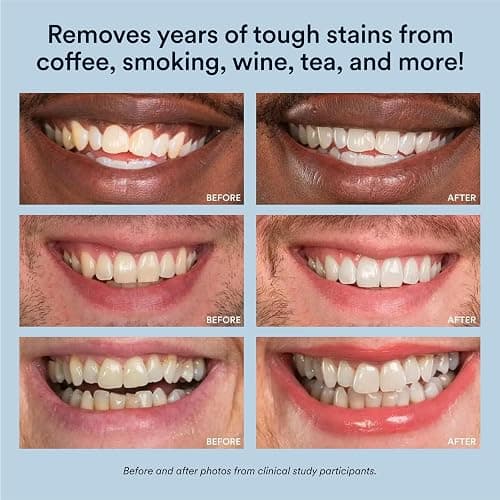 Auraglow Teeth Whitening Kit, LED Accelerator Light, 35% Carbamide Peroxide Teeth Whitening Gel, 20+ Whitening Treatments, Whitens up to 10 Shades in 7 Days thumbnail 6