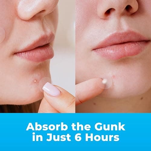 PatchRx Pimple Patches for Face (120 Patches), Hydrocolloid Acne Patches with Tea Tree Oil, Pimple Patch Pimple Stickers - Hydrocolloid Patch Acne Dots - Acne Pimple Patches For Face - Zit Patches thumbnail 5