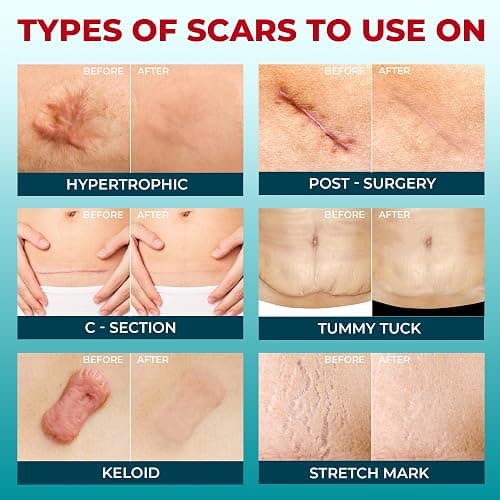 Medical Grade Silicone Scar Tape - 1.6”x150” - Visible Difference on Keloid & С-Section - Reusable Silicone Scar Sheets - Easy to Use - 150"x1.6" - Beige thumbnail 8