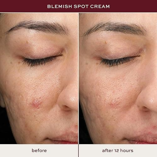 ITK Skincare Salicylic Acid Acne Spot Treatment for Face, Back & Body - Fast Active Acne Relief - Pimple Cream for Acne Prone Skin - Clear Blemishes Fast with Tea Tree Oil - 0.5oz thumbnail 4
