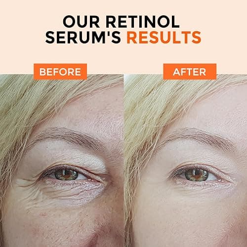 Retinol Serum for Face 2.5%, B5 Resurfacing Retinol Serum with Vitamin C, Vitamin E, Hyaluronic Acid, Niacinamide, Peptide for Anti-Aging, Wrinkle Smoothing, Dark Spot Corrector, Brighten Dullness thumbnail 5