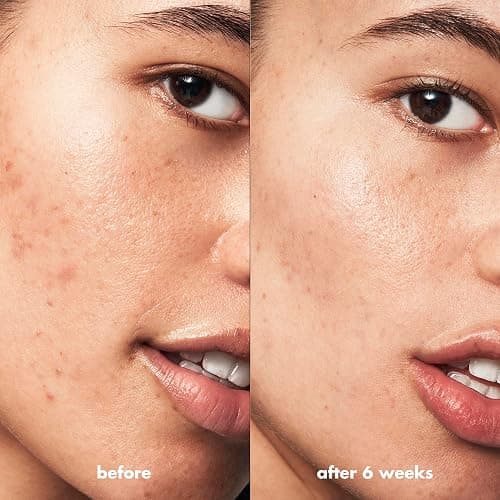e.l.f. SKIN Blemish Breakthrough Acne Fighting Spot Gel, Roll-on For Treating Blemishes, Made With Salicylic Acid, Vegan & Cruelty-Free thumbnail 4