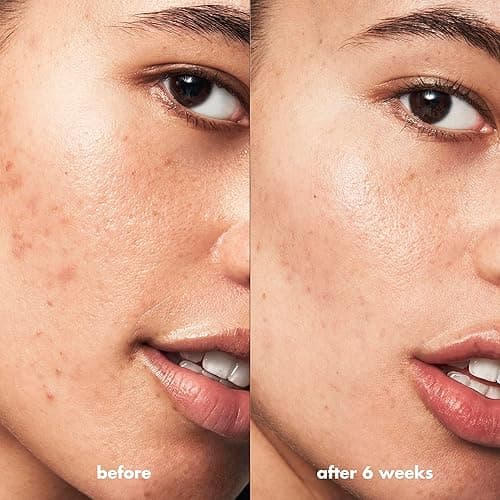 e.l.f. SKIN Blemish Breakthrough Acne Fighting Spot Gel, Roll-on For Treating Blemishes, Made With Salicylic Acid, Vegan & Cruelty-Free thumbnail 5
