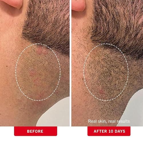 First Aid Beauty - Ingrown Hair Pads with BHA + AHA - Aftershave Treatment Pads to Help Prevent Razor Bumps for Men & Women - Exfoliate Underarms & Bikini Area - Compostable for Daily Use - 28 Pads thumbnail 4