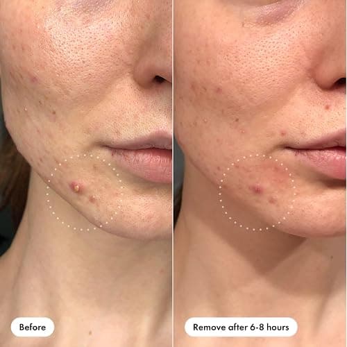 Mighty Patch™ Invisible+ Patch - Daytime Hydrocolloid Acne Pimple Patches for Covering Zits and Blemishes, Ultra Thin Spot Stickers for Face and Skin (24 Medium and 15 Small Patches) thumbnail 3