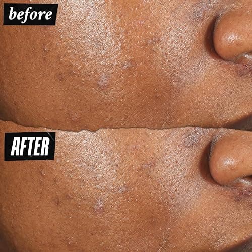 Kiehl's Truly Targeted Acne-Clearing Pimple Patch with 2% Salicylic Acid, Invisible Liquid Spot Treatment, 4% Niacinamide Fades Post-Acne Marks, 0.2% Licorice Root Soothes Redness - 0.5 fl oz thumbnail 3