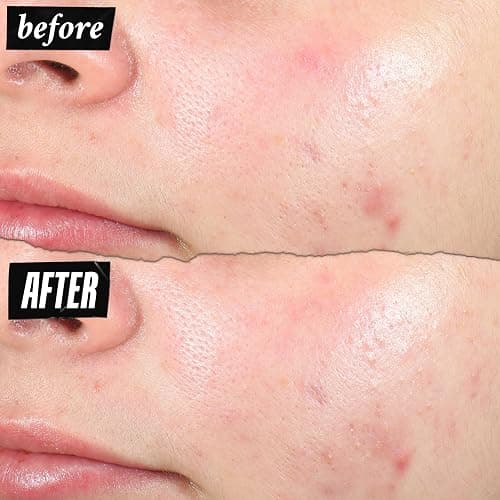 Kiehl's Truly Targeted Acne-Clearing Pimple Patch with 2% Salicylic Acid, Invisible Liquid Spot Treatment, 4% Niacinamide Fades Post-Acne Marks, 0.2% Licorice Root Soothes Redness - 0.5 fl oz thumbnail 5