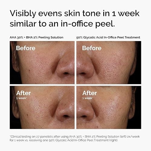 The Ordinary AHA 30% + BHA 2% Peeling Solution, Advanced Exfoliating Peel for Brighter Skin thumbnail 7