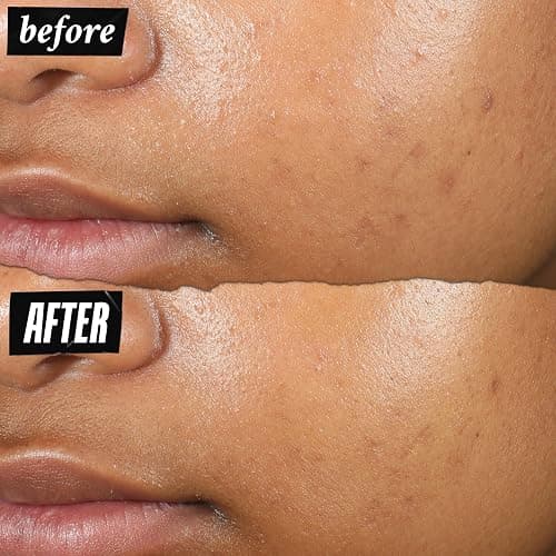 Kiehl's Truly Targeted Acne-Clearing Pimple Patch with 2% Salicylic Acid, Invisible Liquid Spot Treatment, 4% Niacinamide Fades Post-Acne Marks, 0.2% Licorice Root Soothes Redness - 0.5 fl oz thumbnail 4