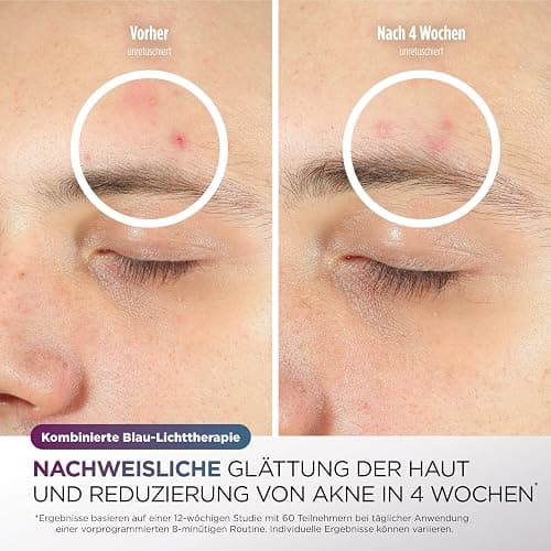 Shark CryoGlow LED Maske, Lichttherapie Maske, Kühlung der Augenpartie, Anti-Aging, Hautklärung, rote/blaue LED, Rotlichtlampe Gesicht, USB-C, Fernbedienung, Schönheitsgeschenke, Kühles Lila FW312EUPL thumbnail 5